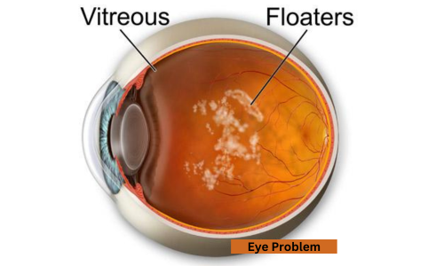 Eye Floaters free eye treatment by netranjali foundation trust